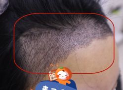 -大麦微针植发全国连锁