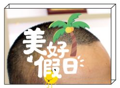 -大麦微针植发全国连锁