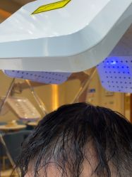 -碧莲盛·不剃发植发