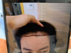-大麦微针植发丨全国连锁