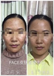 本人自拍，防止盗图，加个水印-元一肌肤管理中心
