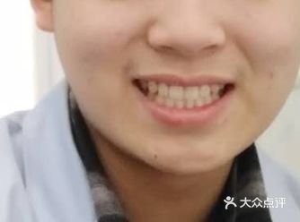 ️洗牙会伤害牙齿吗？     实际上，洗牙不仅不会伤
