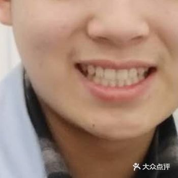 ️洗牙会伤害牙齿吗？     实际上，洗牙不仅不会伤