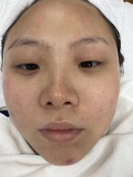 -蕾特恩专业祛痘