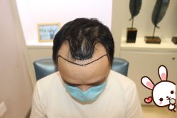 -大麦微针植发丨全国连锁