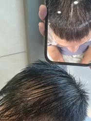 -碧莲盛·不剃发植发