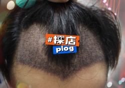 -大麦微针植发全国连锁