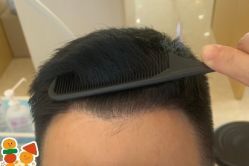 -大麦微针植发丨全国连锁