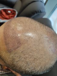 -碧莲盛·不剃发植发