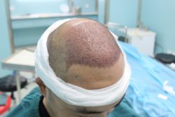 点击看大图 -大麦微针植发丨全国连锁