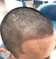 -大麦微针植发丨全国连锁