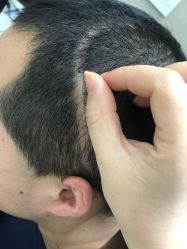 -大麦微针植发全国连锁