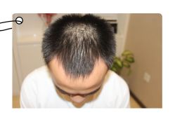 -大麦微针植发全国连锁