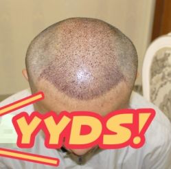 -大麦微针植发丨全国连锁