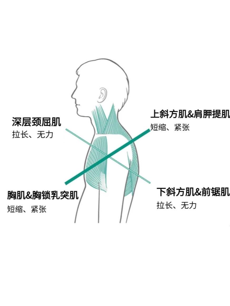 上交叉综合症图图片