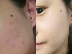 -苗方清颜痘肌研究所