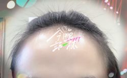 -大麦微针植发全国连锁