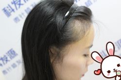 -大麦微针植发丨全国连锁