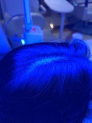 -碧莲盛·不剃发植发