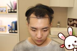 点击看大图 -大麦微针植发丨全国连锁