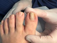 -世龙世家灰指甲鸡眼脚气甲沟炎跖疣护理(通州店)