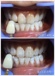 光SPA美白牙齿-光SPA科技美肤