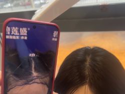 -碧莲盛·不剃发植发