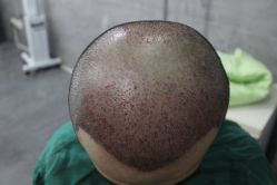 点击看大图 -大麦微针植发丨全国连锁