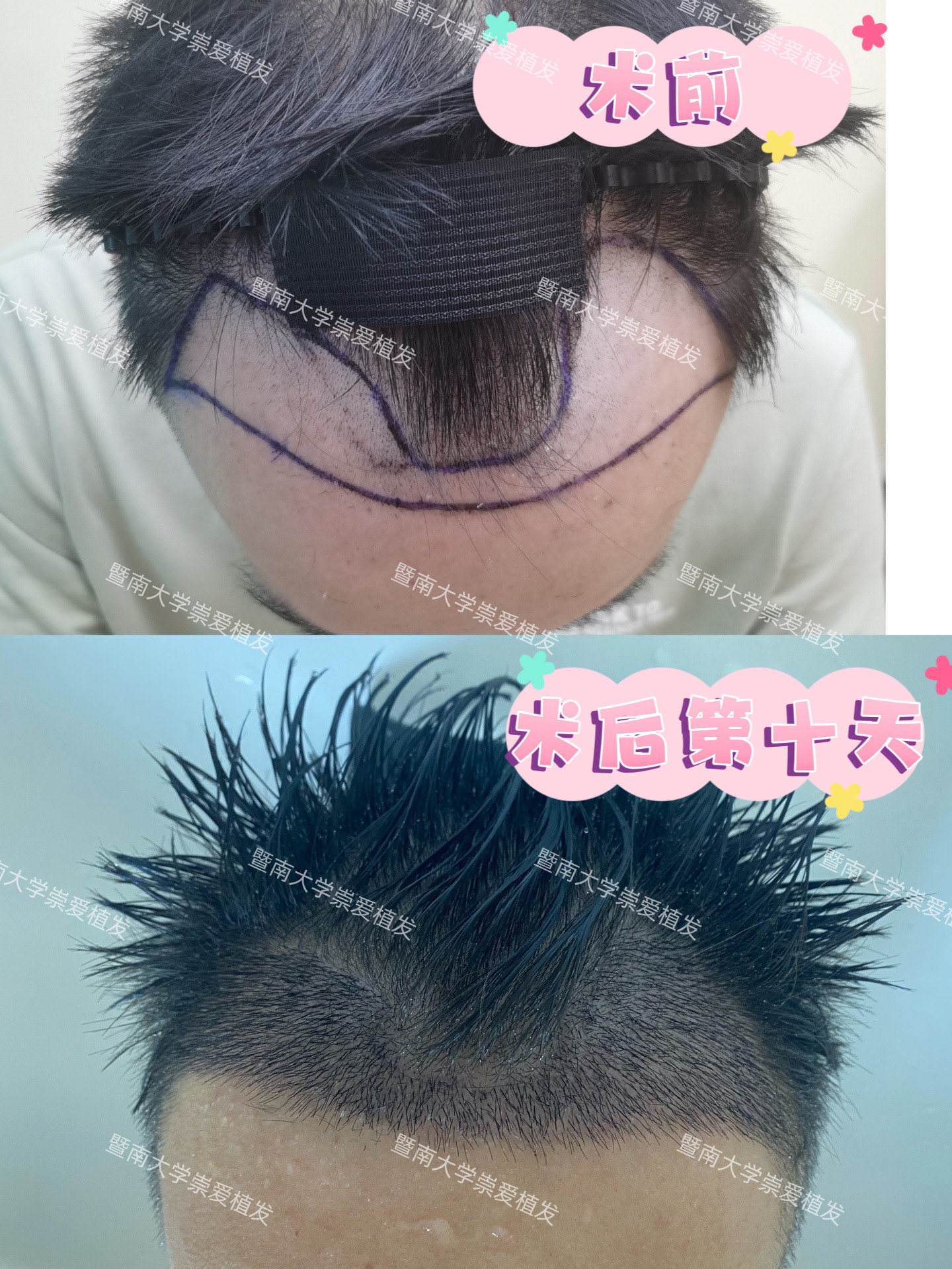 植发需要多久恢复(植发需要多久恢复正常生活)