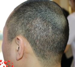 -大麦微针植发丨全国连锁