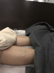 -肥三针腧穴瘦身馆