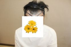-大麦微针植发丨全国连锁