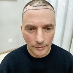 -大麦微针植发丨全国连锁