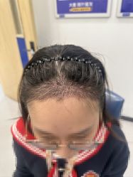 -大麦微针植发全国连锁