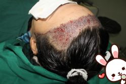 点击看大图 -大麦微针植发丨全国连锁