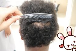 点击看大图 -大麦微针植发丨全国连锁