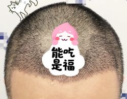 -大麦微针植发全国连锁