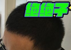 -大麦微针植发丨全国连锁