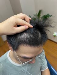 体验后-大麦微针植发全国连锁