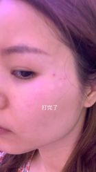 体验后-深圳美莱医疗美容医院