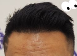 -大麦微针植发全国连锁