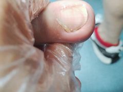 -祖传修脚甲沟炎灰指甲鸡眼