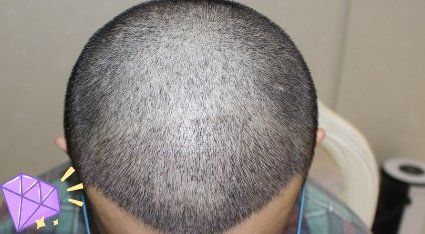 -大麦微针植发丨全国连锁