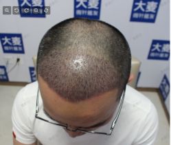 点击看大图 -大麦微针植发丨全国连锁