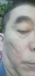 -美丽人生祛斑扁平疣汗管瘤中心