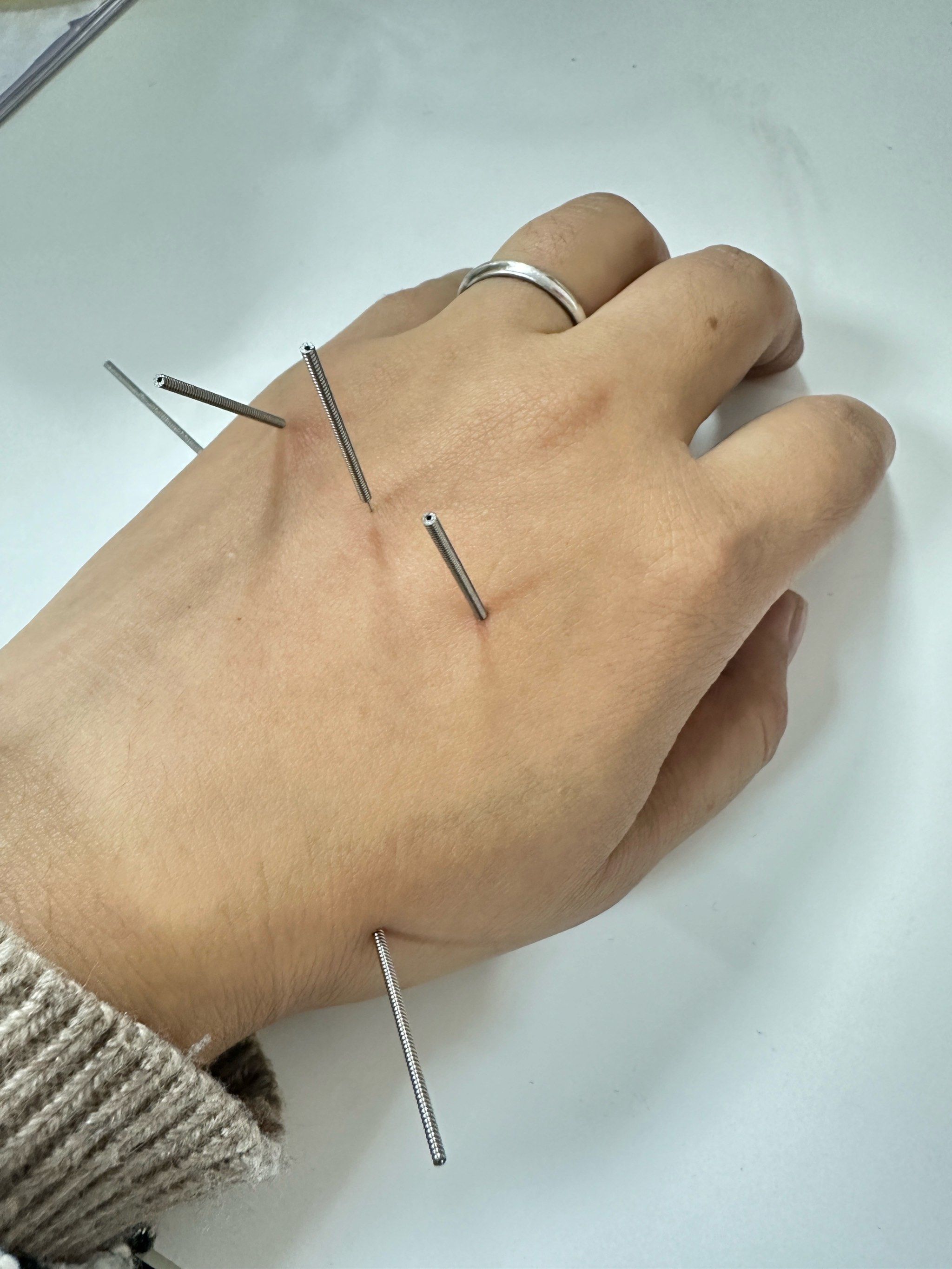 腰扭伤合肥东南外科医院针灸给我治好了,就一次