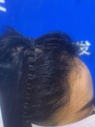 体验后-雍禾植发全国连锁