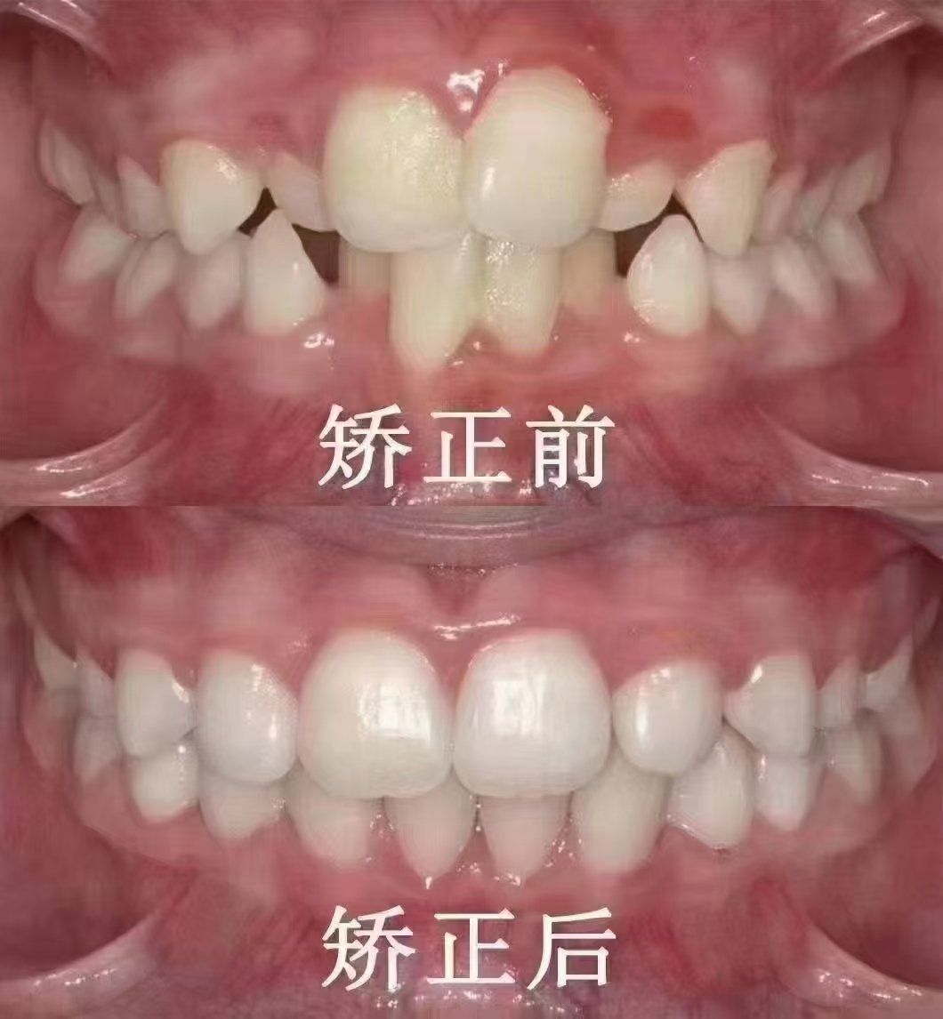 整齐牙齿的魅力