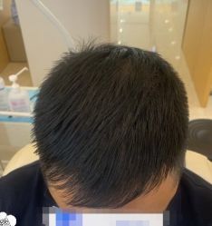 -大麦微针植发丨全国连锁