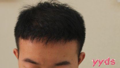 -大麦微针植发丨全国连锁